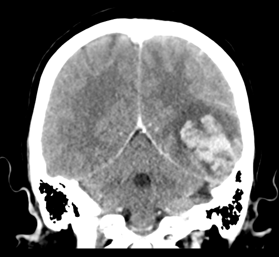 Cerebral venous hemorrhagic infarction (Radiopaedia 57576-64538 Coronal C+ 41).png