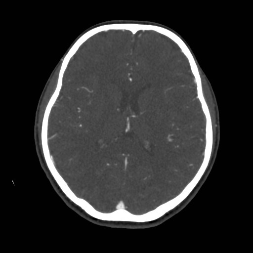 Cerebral venous sinus thrombosis (Radiopaedia 40619-43227 A 130).jpg