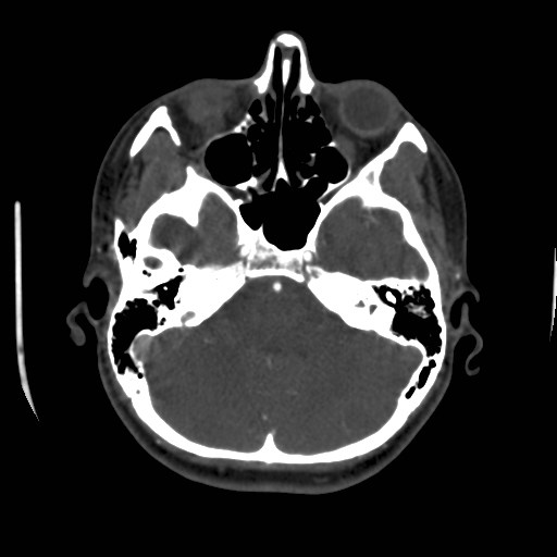 Cerebral venous sinus thrombosis (Radiopaedia 40619-43227 A 53).jpg