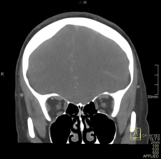 Cerebral venous sinus thrombosis (Radiopaedia 91329-108965 Coronal venogram 25).jpg