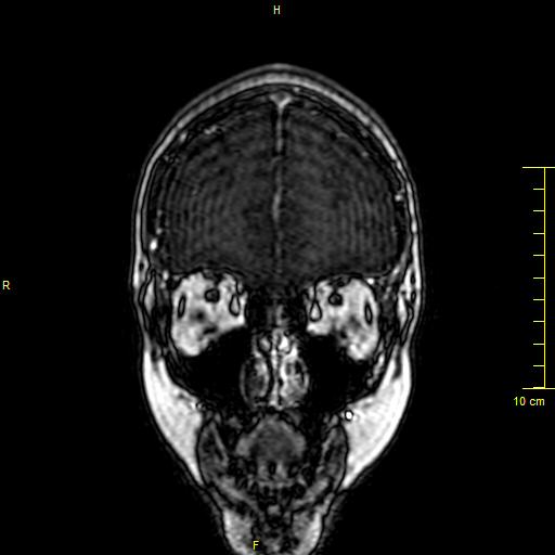 File:Cerebral venous thrombosis (Radiopaedia 23288-23351 MRV 4).JPG