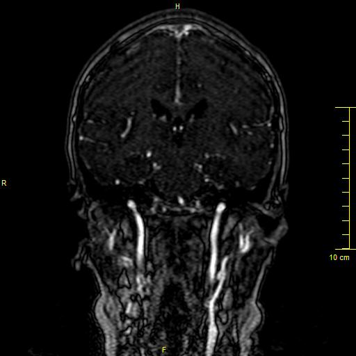Cerebral venous thrombosis (Radiopaedia 23288-23351 MRV 84).JPG