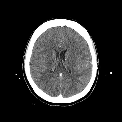 Cerebral venous thrombosis with venous hemorrhagic infarct (Radiopaedia 90354-107660 Axial with contrast 101).jpg