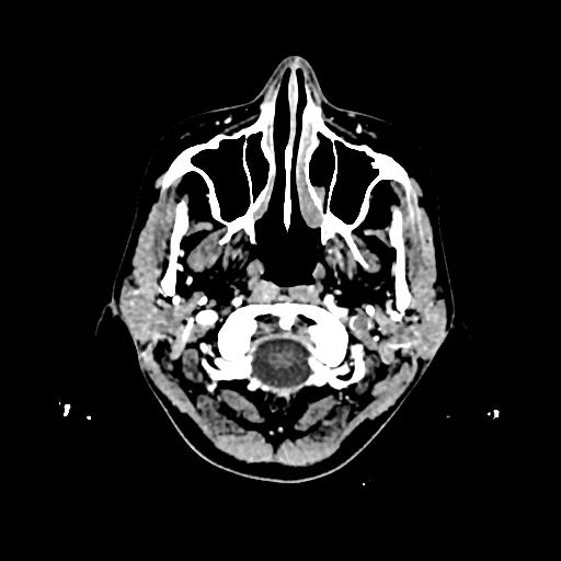 File:Cerebral venous thrombosis with venous hemorrhagic infarct (Radiopaedia 90354-107660 Axial with contrast 6).jpg