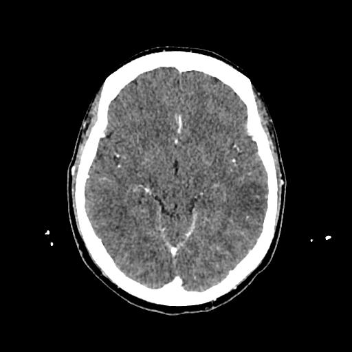Cerebral venous thrombosis with venous hemorrhagic infarct (Radiopaedia 90354-107660 Axial with contrast 73).jpg