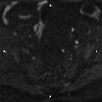 Cervical adenocarcinoma (Radiopaedia 65011-73985 Axial DWI 77).jpg