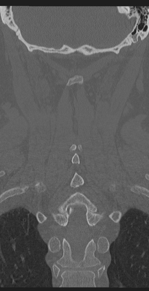 Cervical canal stenosis due to ossification of the posterior longitudinal ligament (Radiopaedia 47260-51823 Coronal bone window 47).png