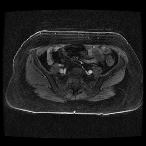 Cervical carcinoma (Radiopaedia 70924-81132 Axial T1 C+ fat sat 161).jpg