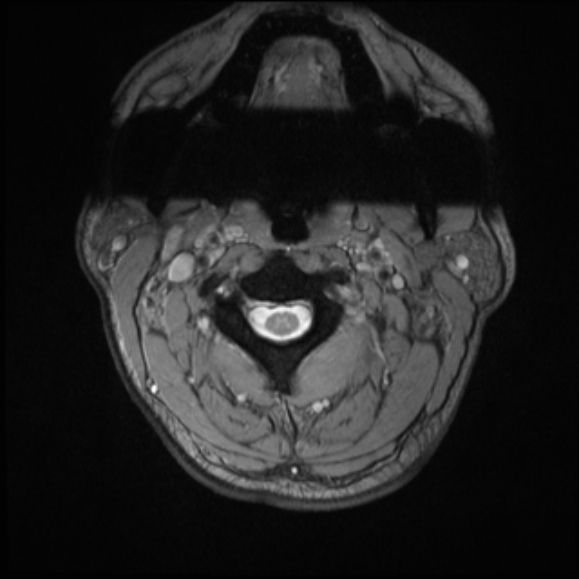File:Cervical disc extrusion (Radiopaedia 53950-60077 Axial T2 3).jpg