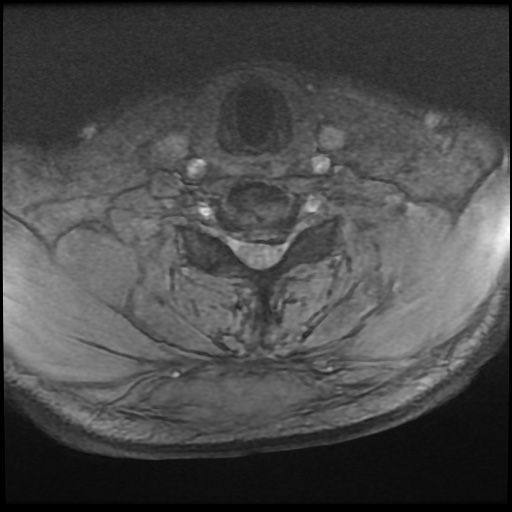 Cervical disc extrusion (Radiopaedia 59074-66364 F 43).jpg