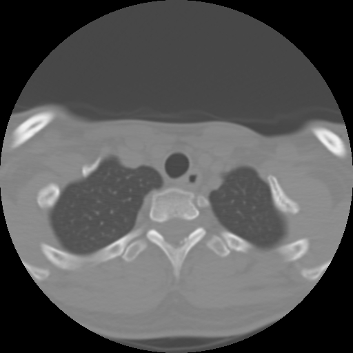Cervical rib (Radiopaedia 71110-81363 Axial non-contrast 51).jpg