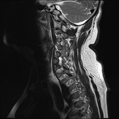 File:Cervical spinal neurofibroma in a patient with NF1 (Radiopaedia 58344-65465 Sagittal T2 2).jpg
