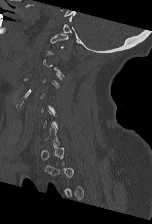 Cervical spine ACDF loosening (Radiopaedia 48998-54070 Sagittal bone window 61).png