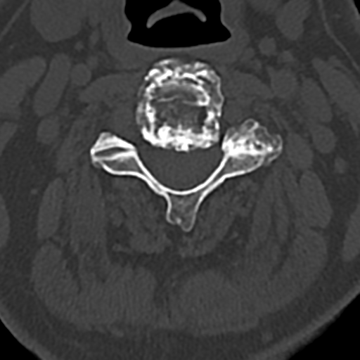 File:Cervical spine fracture - chalk stick (Radiopaedia 39116-41323 Axial bone window 37).png