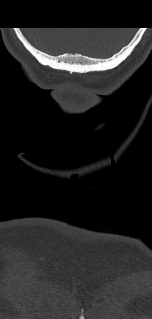 Cervical spine fracture - chalk stick (Radiopaedia 39116-41323 Coronal bone window 67).png