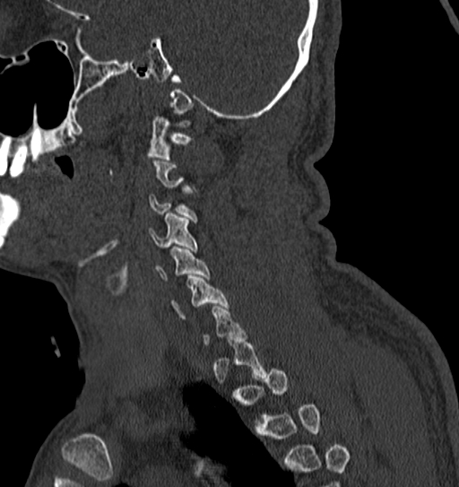 Cervical spine trauma with tear drop fracture and perched facet joint (Radiopaedia 53989-60127 Sagittal bone window 28).jpg