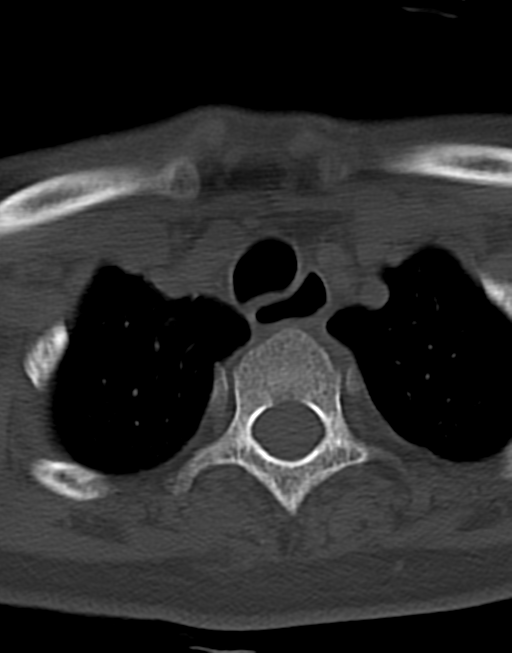 Cervical tuberculous spondylitis (Radiopaedia 39149-41365 Axial bone window 51).png