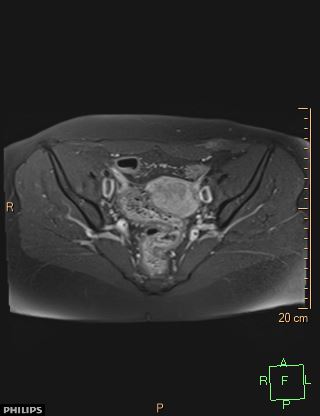 File:Cesarian scar endometriosis (Radiopaedia 68495-78066 Axial T1 C+ fat sat 10).jpg