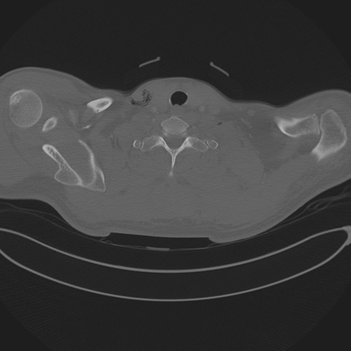 File:Chest multitrauma - aortic injury (Radiopaedia 34708-36147 Axial bone window 1).png