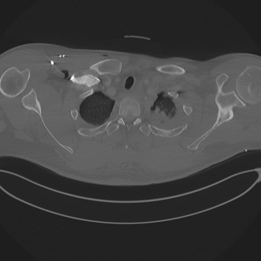 Chest multitrauma - aortic injury (Radiopaedia 34708-36147 Axial bone window 36).png