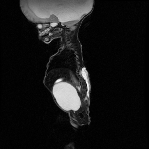 File:Chiari II malformation with spinal meningomyelocele (Radiopaedia 23550-23652 Sagittal T2 8).jpg
