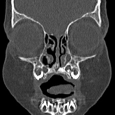 Choanal atresia (Radiopaedia 88525-105975 Coronal bone window 13).jpg