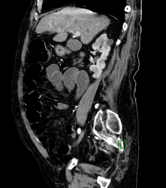 Cholangiocarcinoma with cerebral metastases (Radiopaedia 83519-98629 F 78).jpg