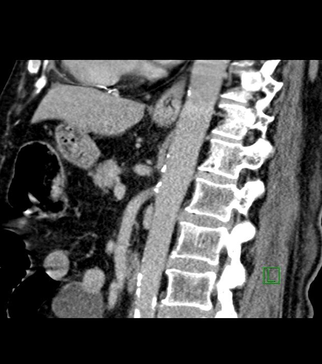 Cholangiocarcinoma with cerebral metastases (Radiopaedia 83519-98629 Sagittal C+ delayed 52).jpg