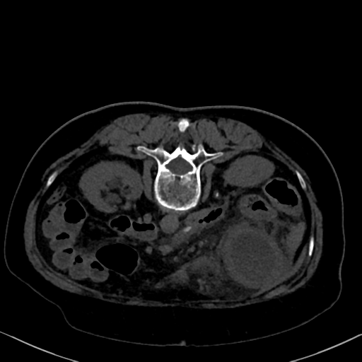 File:Cholecystitis - obstructive choledocholitiasis (CT intravenous cholangiography) (Radiopaedia 43966-47479 Axial 36).png