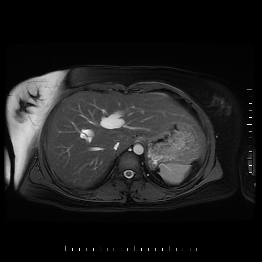 File:Choledochal cyst with chronic calcific pancreatitis (Radiopaedia 18245-18062 Axial T2 2).png