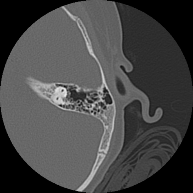 Cholesteatoma (Radiopaedia 73023-83750 Axial Left ear 63).jpg