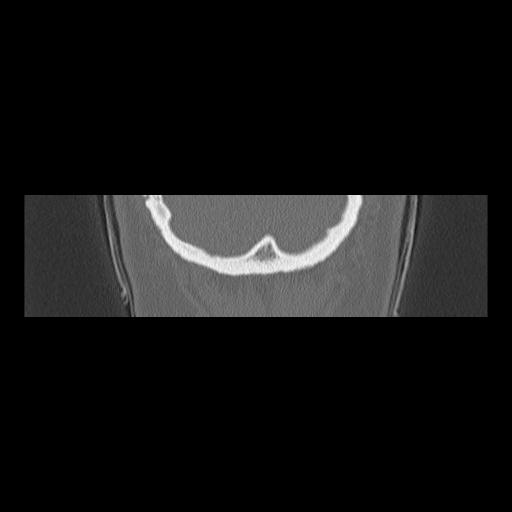 Cholesteatoma (Radiopaedia 84946-100455 Coronal bone window 158).jpg