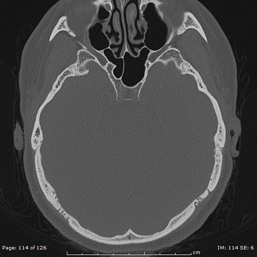 Cholesteatoma - external auditory canal (Radiopaedia 88452-105096 Axial bone window 77).jpg