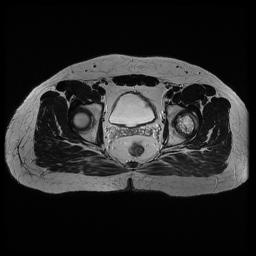 File:Chondroblastoma (Radiopaedia 12264-12564 Axial T2 7).jpg