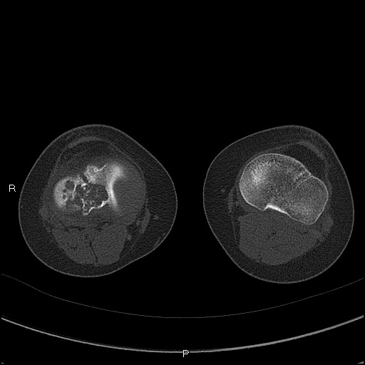 File:Chondroblastoma (Radiopaedia 62721-71030 Axial bone window 45).jpg