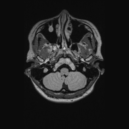 Chondrosarcoma (Radiopaedia 41937-44939 Axial FLAIR 20).png