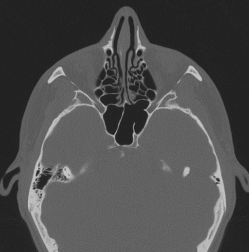 Chondrosarcoma (clivus) (Radiopaedia 46895-51425 Axial bone window 39).png