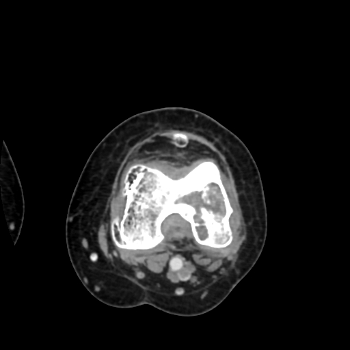 Chondrosarcoma - femur (Radiopaedia 64187-72954 Axial with contrast 51).jpg