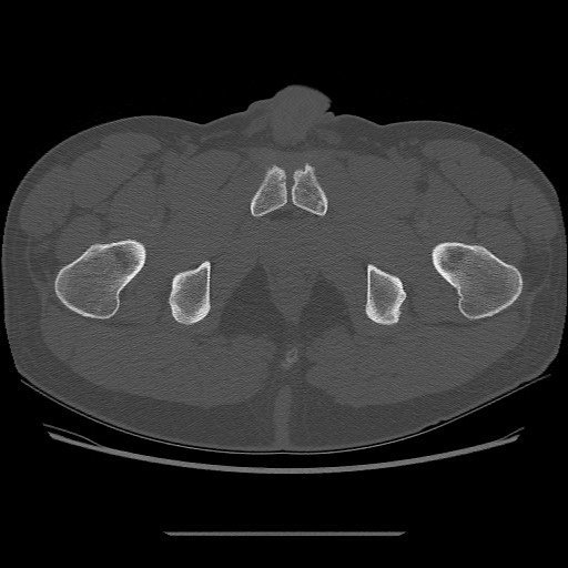 File:Chondrosarcoma of iliac wing (Radiopaedia 63861-72599 Axial bone window 118).jpg