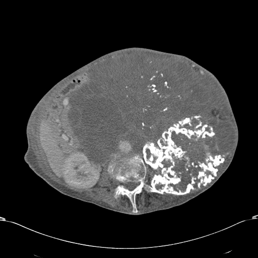 Chondrosarcoma of the spine (Radiopaedia 49871-55143 A 31).jpg