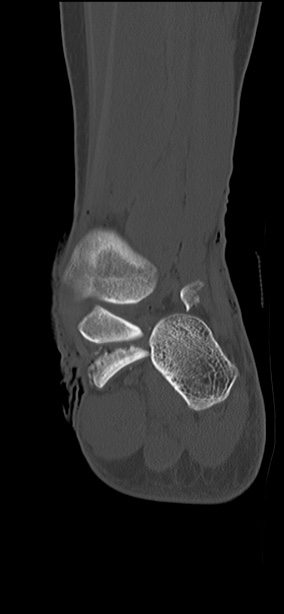 Chopart fracture (Radiopaedia 35347-36851 Coronal bone window 23).jpg
