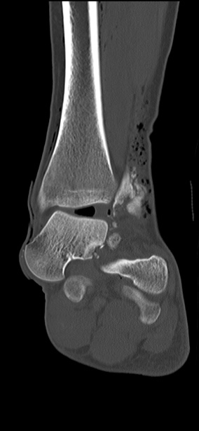 Chopart fracture (Radiopaedia 35347-36851 Coronal bone window 36).jpg