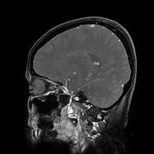 File:Chordoid glioma of third ventricle (Radiopaedia 91612-109340 F 132).jpg