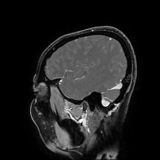 Chordoid glioma of third ventricle (Radiopaedia 91612-109340 F 52).jpg