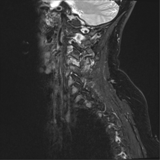 File:Chordoma (C4 vertebra) (Radiopaedia 47561-52189 Sagittal T2 fat sat 13).png