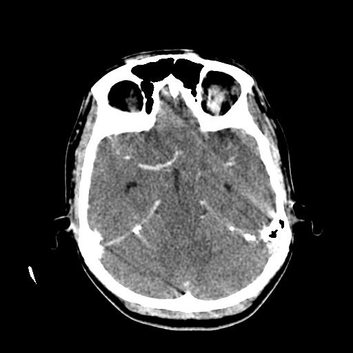 File:Choriocarcinoma of ovary with cerebral and pulmonary metastases (Radiopaedia 25983-26118 C+ arterial phase 53).jpg
