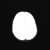 File:Choroid plexus papilloma (Radiopaedia 84612-100019 Axial DWI 18).jpg