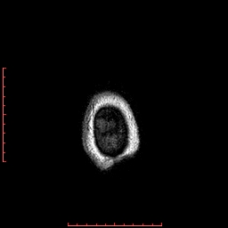 Choroid plexus xanthogranuloma (Radiopaedia 67843-77270 Axial T1 15).jpg