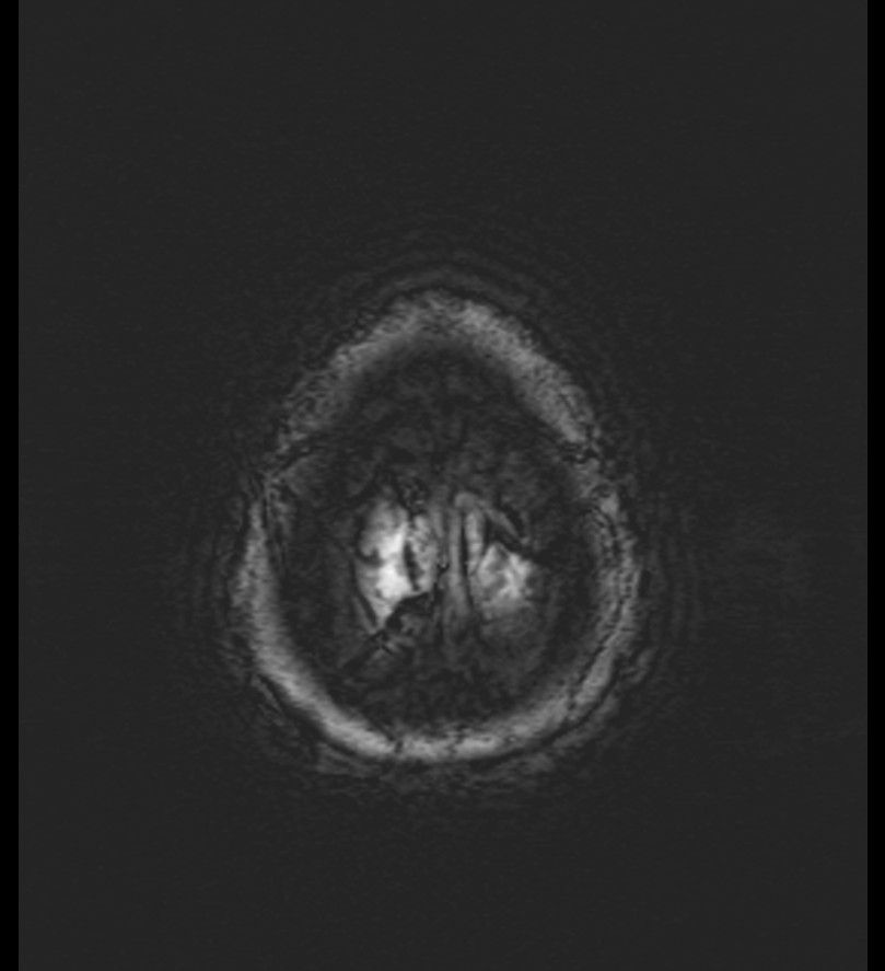 Choroid plexus xanthogranuloma (Radiopaedia 91271-108875 Axial SWI 59).jpg
