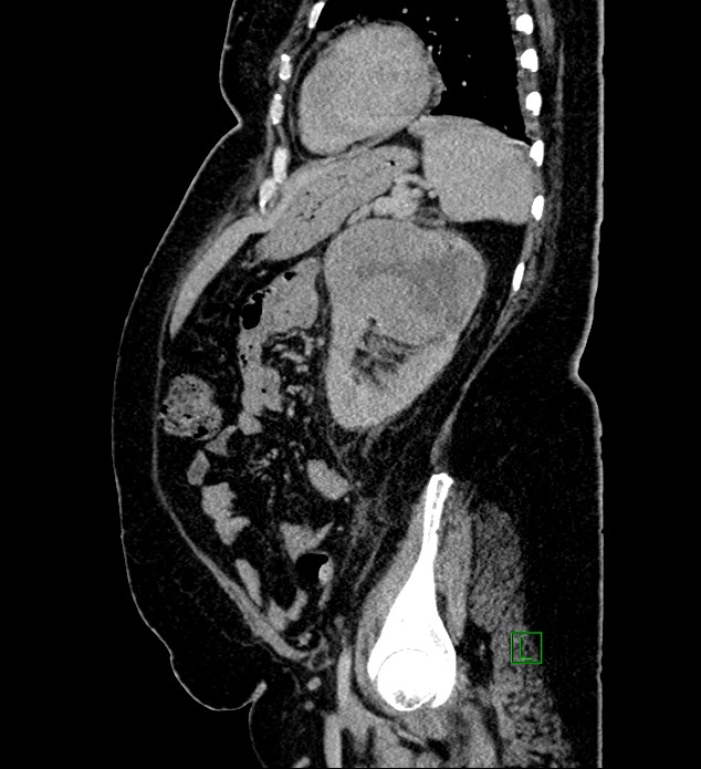 Chromophobe renal cell carcinoma (Radiopaedia 84239-99519 G 36).jpg